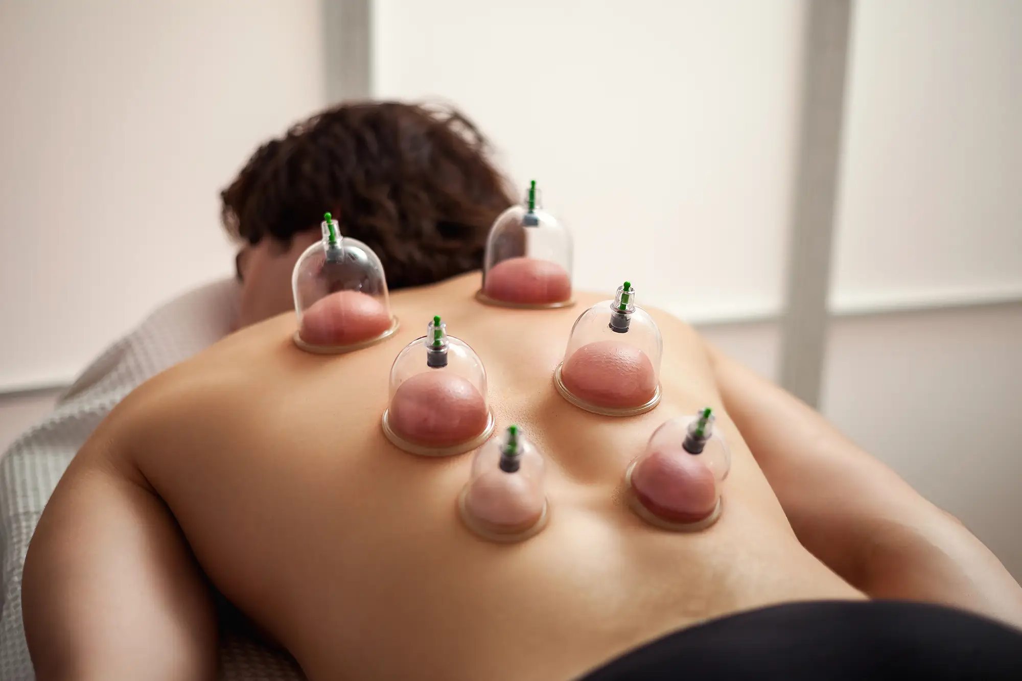 cupping-1