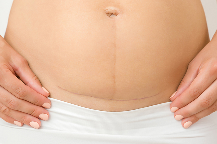 c-section-luna-physio copy